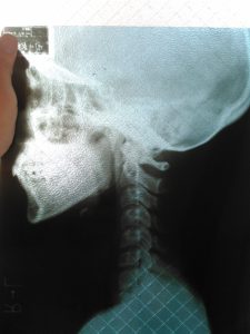 首頚椎のレントゲン